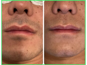 クリア 尾張旭店(Clear)/【Clear脱毛ビフォーアフター】