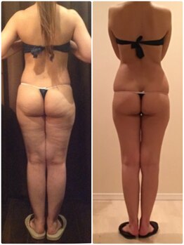 プラチナアース つくば店(Platinum earth)/痩身ビフォーアフター