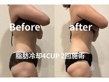 ユー 喜連西店(U)/脂肪冷却【before　after】