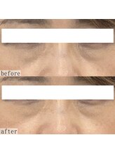 ヴェルシック(Belchic)/切らない目の下のたるみ改善