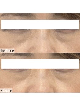 ヴェルシック(Belchic)/切らない目の下のたるみ改善