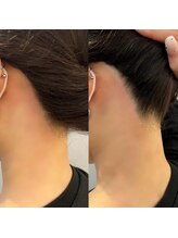 バレベッカ(Ballebecca)/うなじ wax脱毛☆