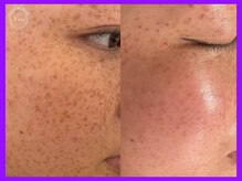 ハーブピーリング 名古屋/光ピール施術　シミ改善