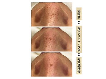 グラツィア(Grazia)/毛穴エステ