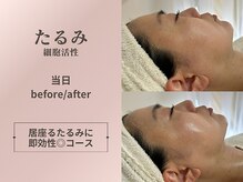 ウララカ(uraraca)の雰囲気(何もしないとどんどん進む老け顔原因のたるみを改善!)
