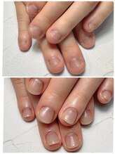 スマイルニコ(smile nico)/介護士さんの深爪矯正