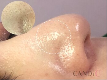 キャンディ 名古屋金山店(CANDi)/ハイドラピーリング黒ずみ毛穴◎