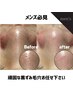 【メンズ|黒ずみ毛穴】毛穴レスコース(110分)¥13,000→
