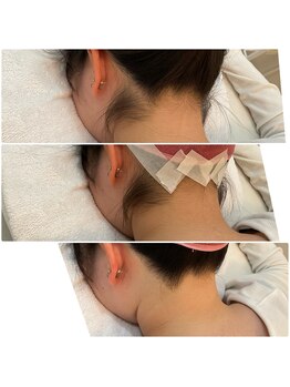プレヴェール 神戸三宮/うなじ脱毛 襟足(えりあし)脱毛