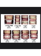 エクシアホワイト 立川南口店/プレミアムホワイトニング