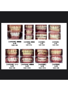 エクシアホワイト 立川南口店/プレミアムホワイトニング