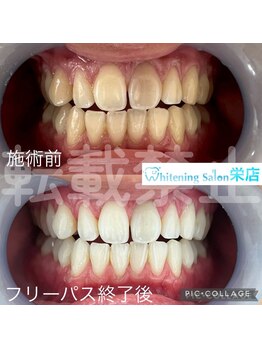 ホワイトニングサロン 名古屋 栄店/【ホワイトニング】