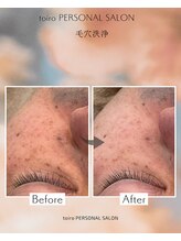 トイロ(toiro)/毛穴洗浄　ハイドラスキン