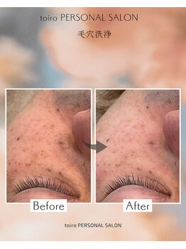 トイロ(toiro)/毛穴洗浄　ハイドラスキン