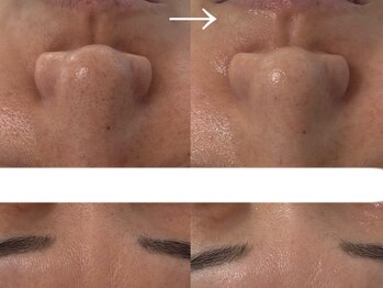シェリー(cherie)の写真/【桜山/毛穴根本改善】30歳からの詰まり・開き・たるみ毛穴を徹底洗浄。敏感肌でも叶う毛穴レス艶肌へ