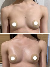 ルナグランデ(Luna grande.)/左右差改善