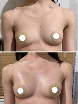 ルナグランデ(Luna grande.)/左右差改善