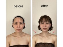 リラココ(リラcoco)/ビフォーアフター（30代お客様）