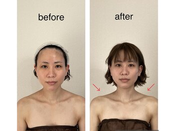 リラココ(リラcoco)/ビフォーアフター(30代お客様)