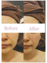 ブランシェ 高岡店 × 椿/シワ・たるみケア　お客様