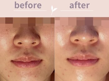 アール(R)/１度でこのツヤ！