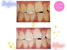 エクシアホワイト 立川南口店/ビフォーアフター
