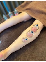 ハリキュア(Hari-Cure)/カッピング(吸い玉)