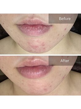 ルナート(Lunart)/ハーブピーリング【顔】