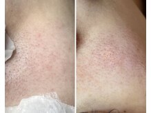 エヌエクラ(N.eclat.)/毛穴エクストラクション(頬)