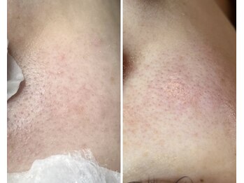 エヌエクラ(N.eclat.)/毛穴エクストラクション(頬)