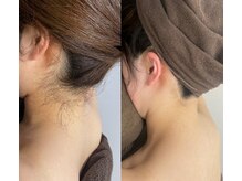 ミース 宮崎店/うなじ脱毛の効果Before→After