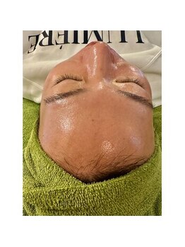 メディカルサンテロッソ 福岡店(MEDICAL SANTEROSSO)/水光ピール施術後