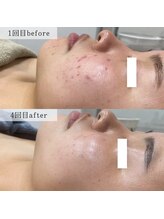 ネイルズビー 別邸(Nail's be)/ハーブピーリング