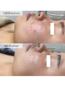 ネイルズビー 別邸(Nail's be)/ハーブピーリング