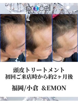 アンドエモン(&EMON)/【頭皮】プロセル効果