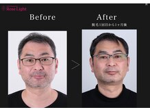 ヘルディン(heldin +555)/メンズ脱毛