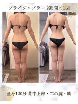 エヌア(nA)の写真/【初回全身12100円】短期間で二の腕・背中痩せが叶う最新痩身！ドレスを着こなす華奢ボディへ♪無料相談も