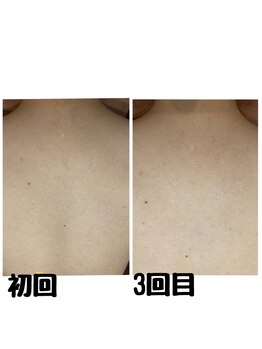パルティノ 高崎店/【症例】背中脱毛☆３回目☆