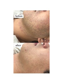 エリクサー 太田店(Elixir)/before after