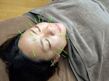 のなか鍼灸院/美容鍼
