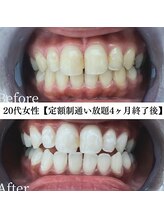 ホワイト 福岡天神店(WHITE)/ホワイトニングビフォーアフター