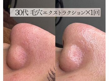 ル シーニュ/毛穴エクストラクション