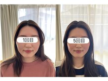 黒田鍼灸治療院/ブライダル美容鍼小顔ケア