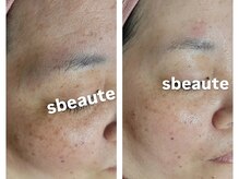 エスボーテ(sbeaute)/プラズマ×ダクトピール