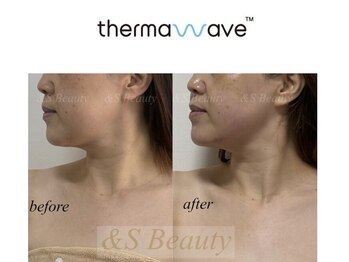 アンドエスビューティ(&S Beauty)/フェイスラインすっきり!!