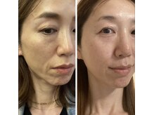 トータルエステティック ジョワイユ(JOYEUX)の雰囲気(最先端美容プラズマ×導入ケア/シミくすみ改善/毛穴ケア)