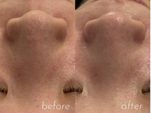 サロン エム(saron M)の雰囲気（毛穴洗浄で皮脂や角栓、古い角質を取り除いて肌荒れ予防に！！）