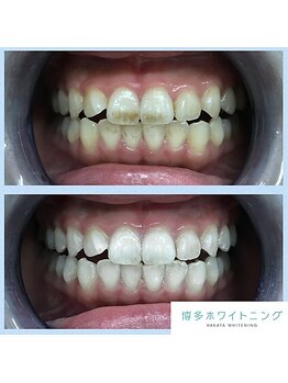 博多ホワイトニング福岡 小倉駅前店/効果抜群!驚きのbefore&after