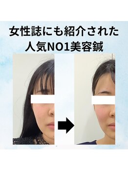 ゆず鍼灸整骨院/GINGERに紹介された美容鍼