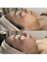 サロン ド ブラン アオヤマ(Salon de BLANC AOYAMA)/BIOPHYTO×Sonocare90min